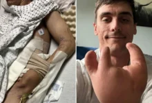 degloving injury