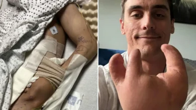 degloving injury