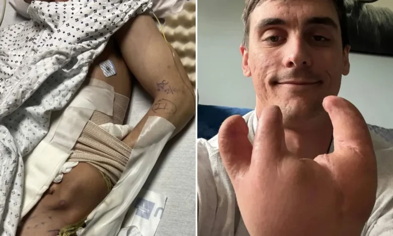 degloving injury